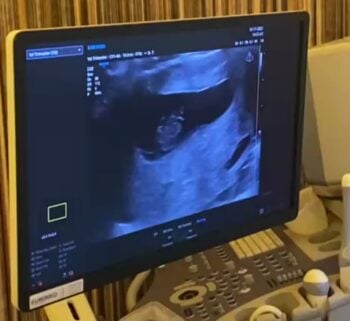 Monitor z obrazem ultrasonograficznym ciąży na ekranie urządzenia medycznego